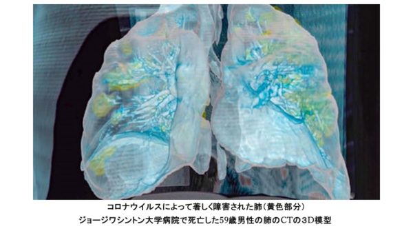 パンデミックの中で。COVID-19というウイルスの厄介さ